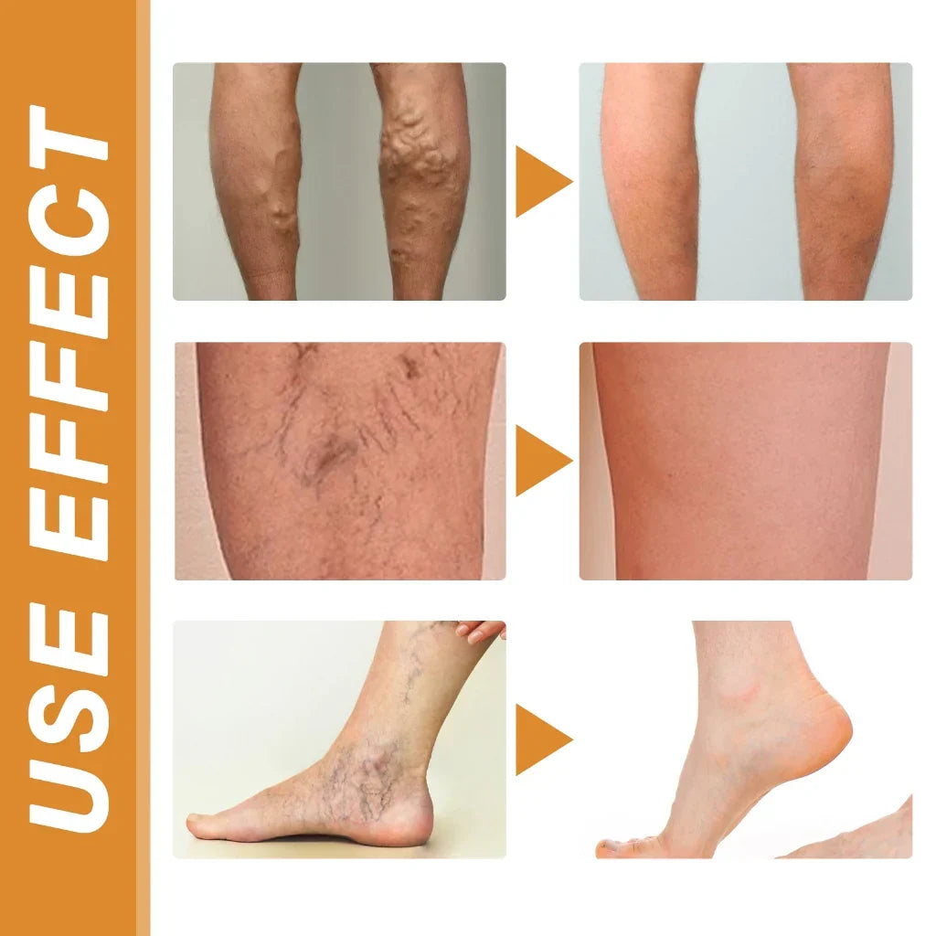 Turmeric Varicose Relief Spray